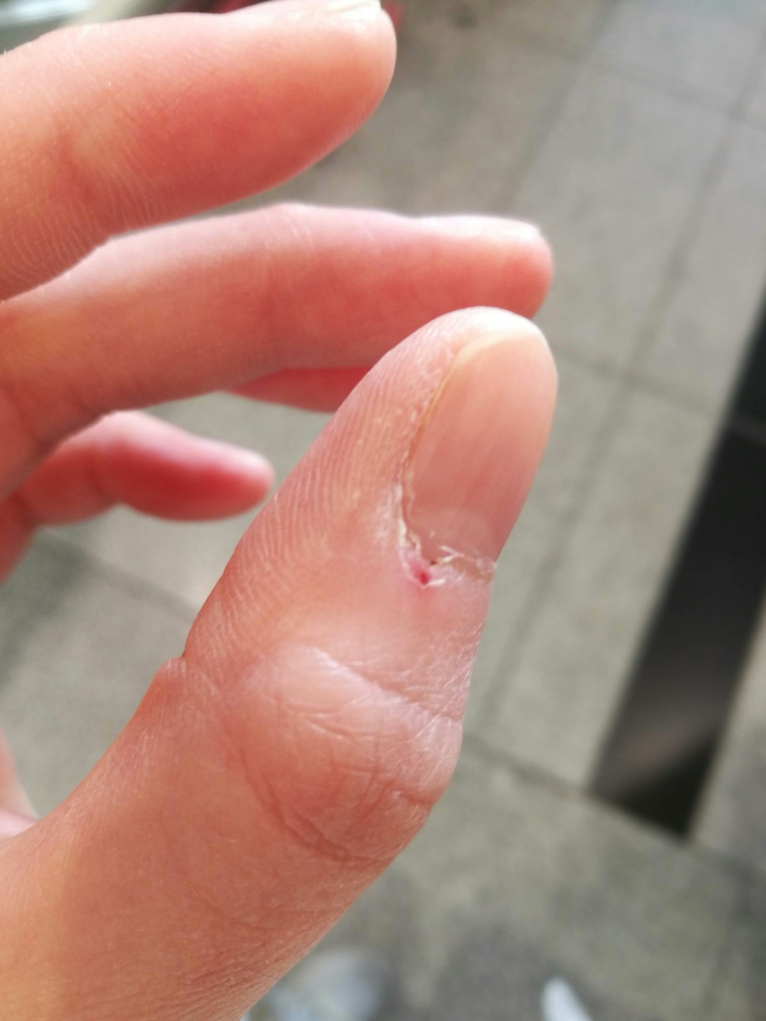 手部图像显示手指上的伤口