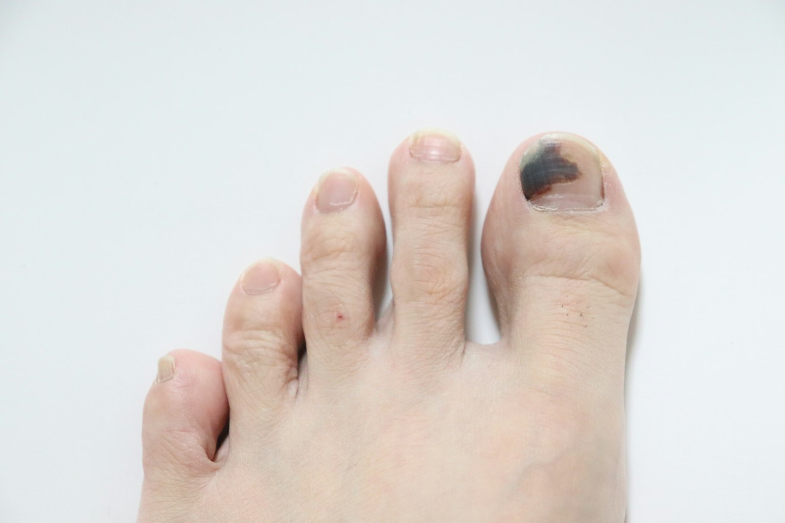Pied avec un ongle de pied meurtri et des orteils visibles