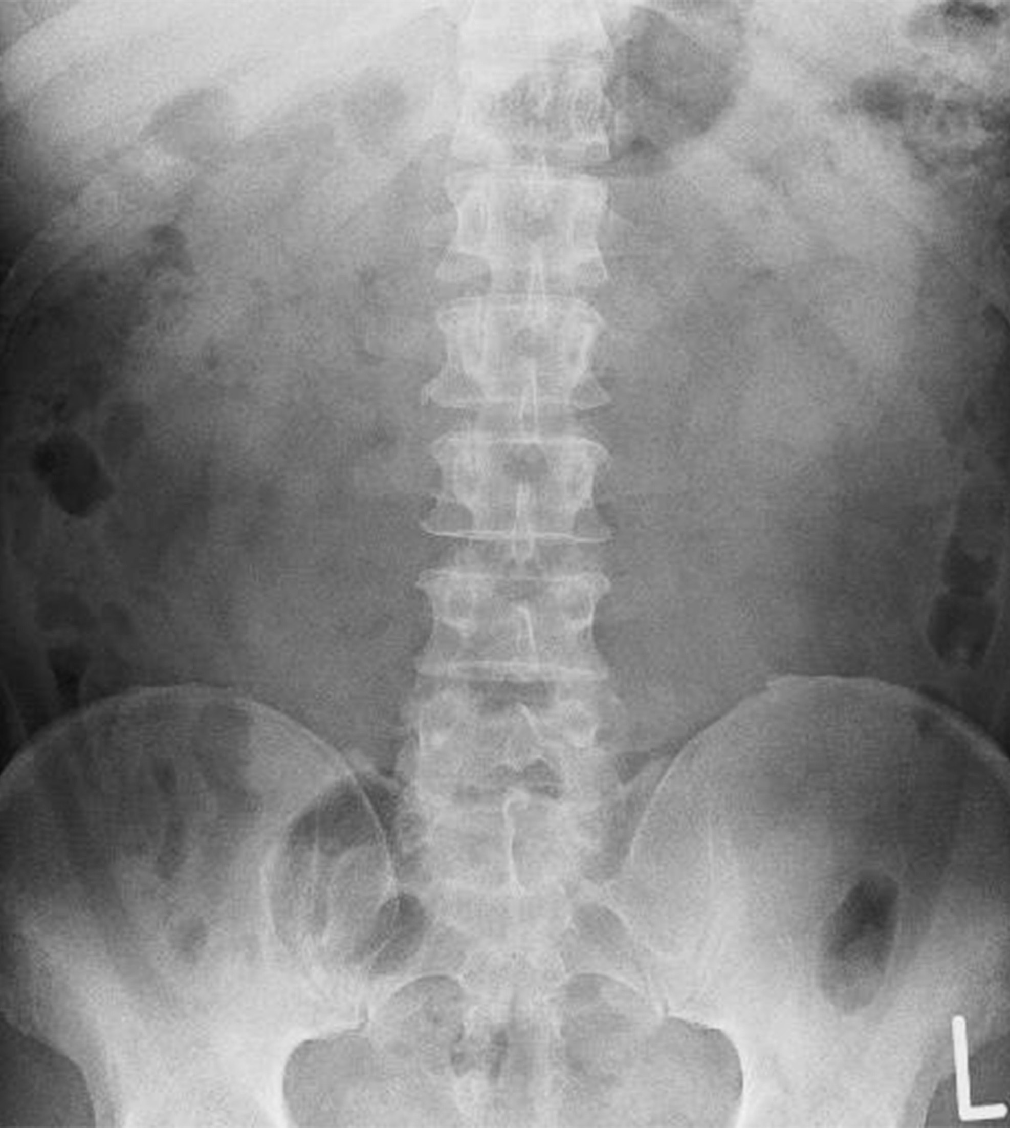 腹部X光片顯示脊柱和骨盆