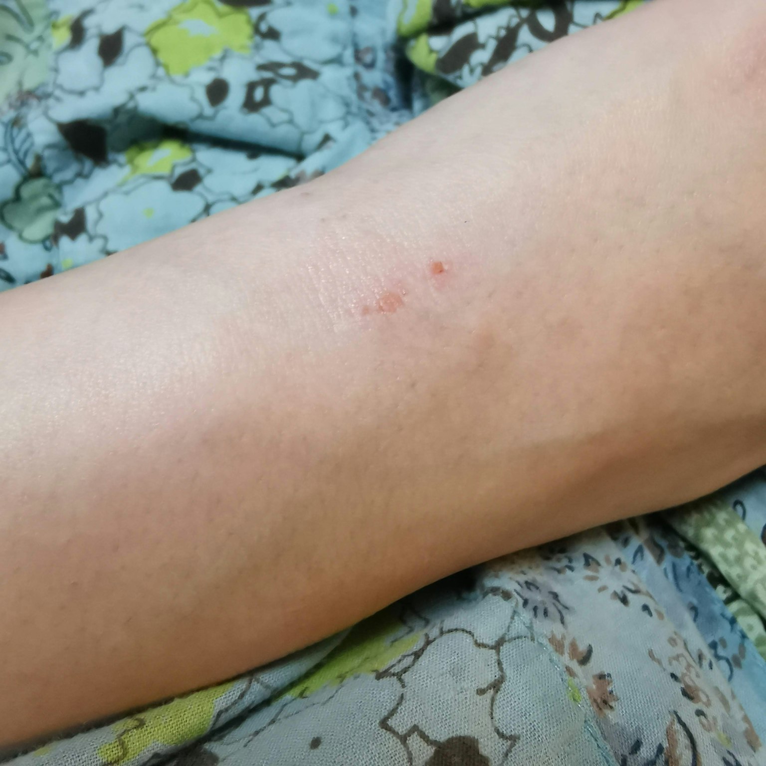 Gros plan de la peau sur la cheville montrant une marque rouge
