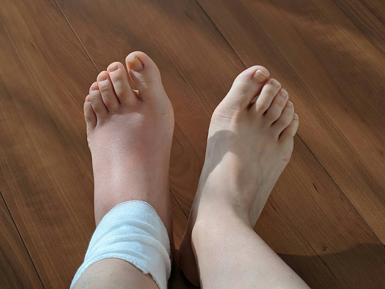 Un pied enflé avec un bandage à côté d'un pied sain sur un sol en bois